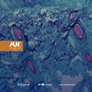 جدري القرود