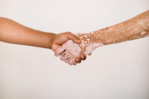 كريم لعلاج البهاق قد يسمح به في المملكة المتحدة