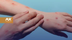 جدري القرود