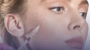 إبرة النضارة