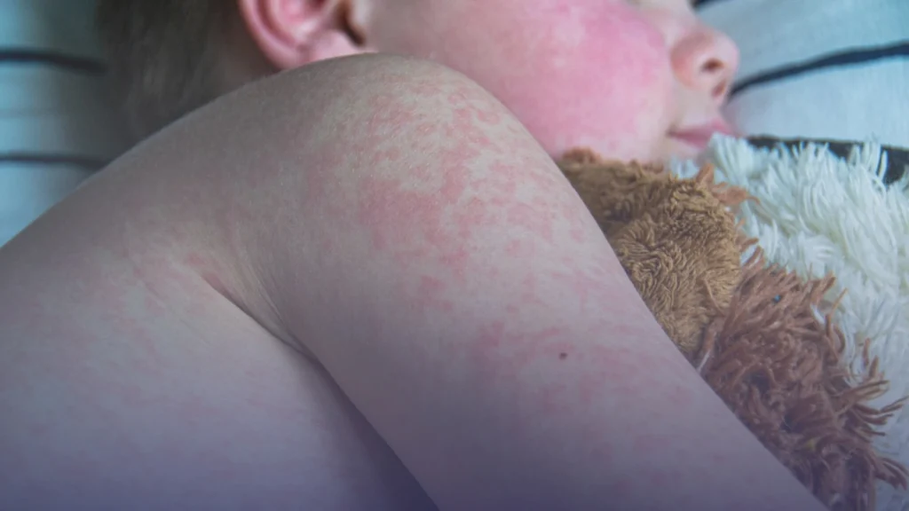 هل تعود الحصبة للانتشار في بريطانيا؟ منظمة الصحة العالمية تحذر