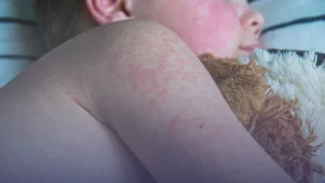 هل تعود الحصبة للانتشار في بريطانيا؟ منظمة الصحة العالمية تحذر