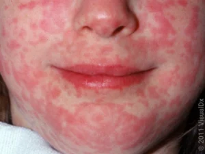 تراجع معدلات تطعيم الحصبة في إنجلترا: خبراء يصفون النظام الحالي بـ "الفاشل"