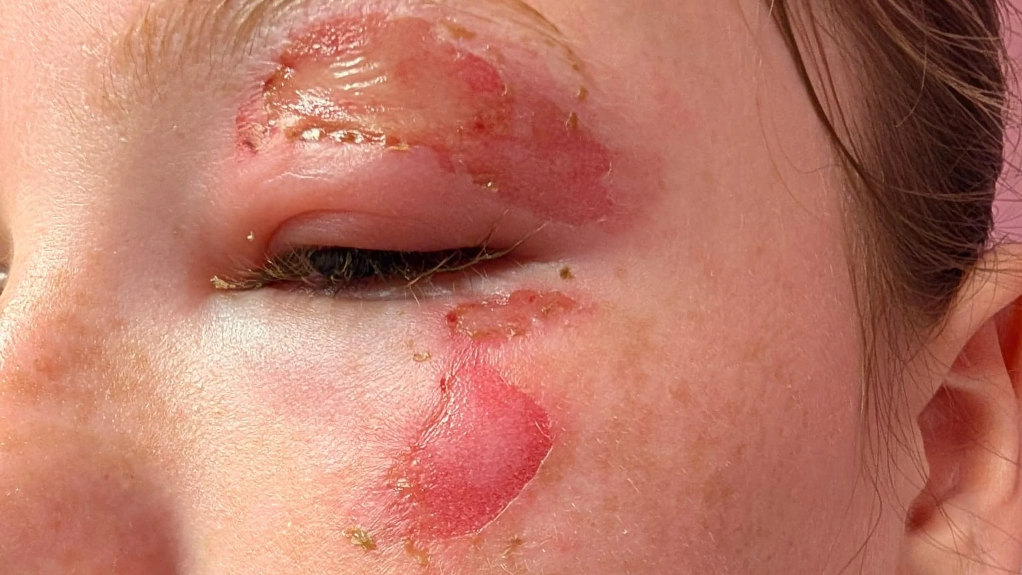 تحذير طبي عاجل: ألعاب تسبب حروقًا خطيرة للأطفال بسبب "تريند" قاتل